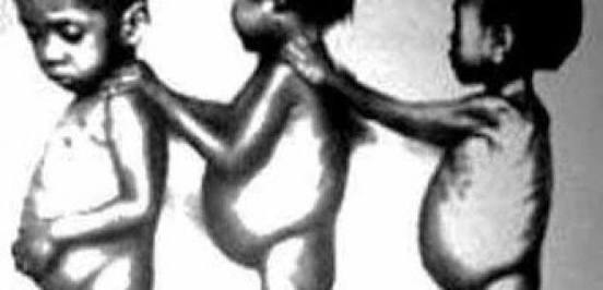 71 Anak Meninggal Dunia Akibat Gizi Buruk dan Campak