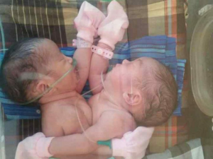 Bayi Kembar Siam Azila dan Akila Berharap Uluran Tangan Dermawan