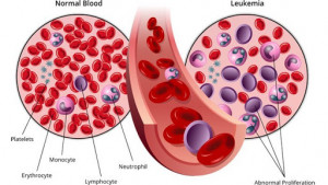 Mari Kenali  Gejala Penyakit  Mematikan 'Kanker Darah'